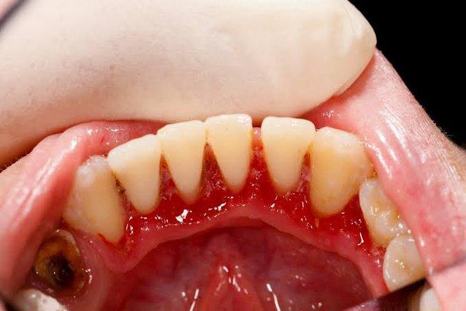 Can Gum Disease Be Reversed Before It Causes Tooth Loss? | Articles | Quail Lakes Dental Care | Gan Jing World - Technology for Humanity | Video & Movie Streaming