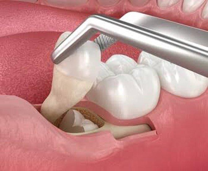 How Do You Know If You Need a Root Canal or a Tooth Extraction? | Articles | Concord Dental & Orthodontics | Gan Jing World - Technology for Humanity | Video & Movie Streaming