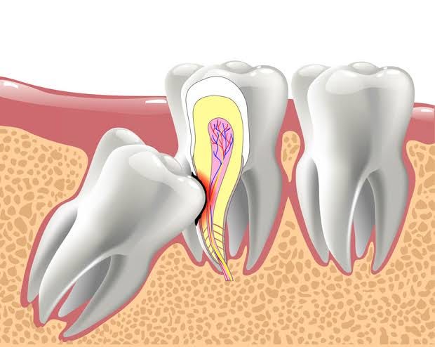 Why Wisdom Teeth Problems Can Develop Without Warning